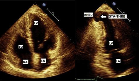 what is ventricular aneurysm